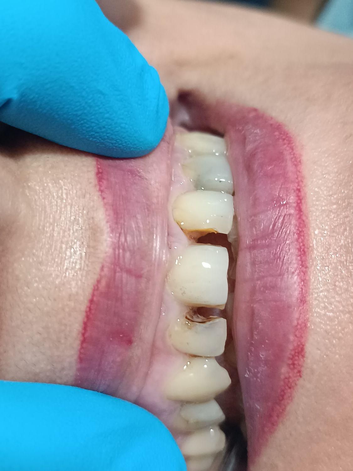 کامپوزیت دندان|خدمات آرایشگری و زیبایی|نورآباد, |دیوار