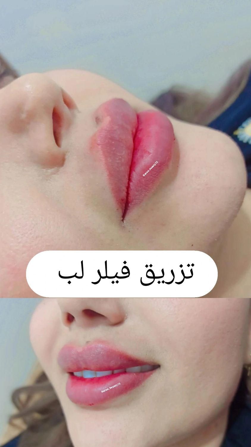 آموزش تزریق ژل بوتاکس و...|خدمات آموزشی|خرم‌آباد, |دیوار