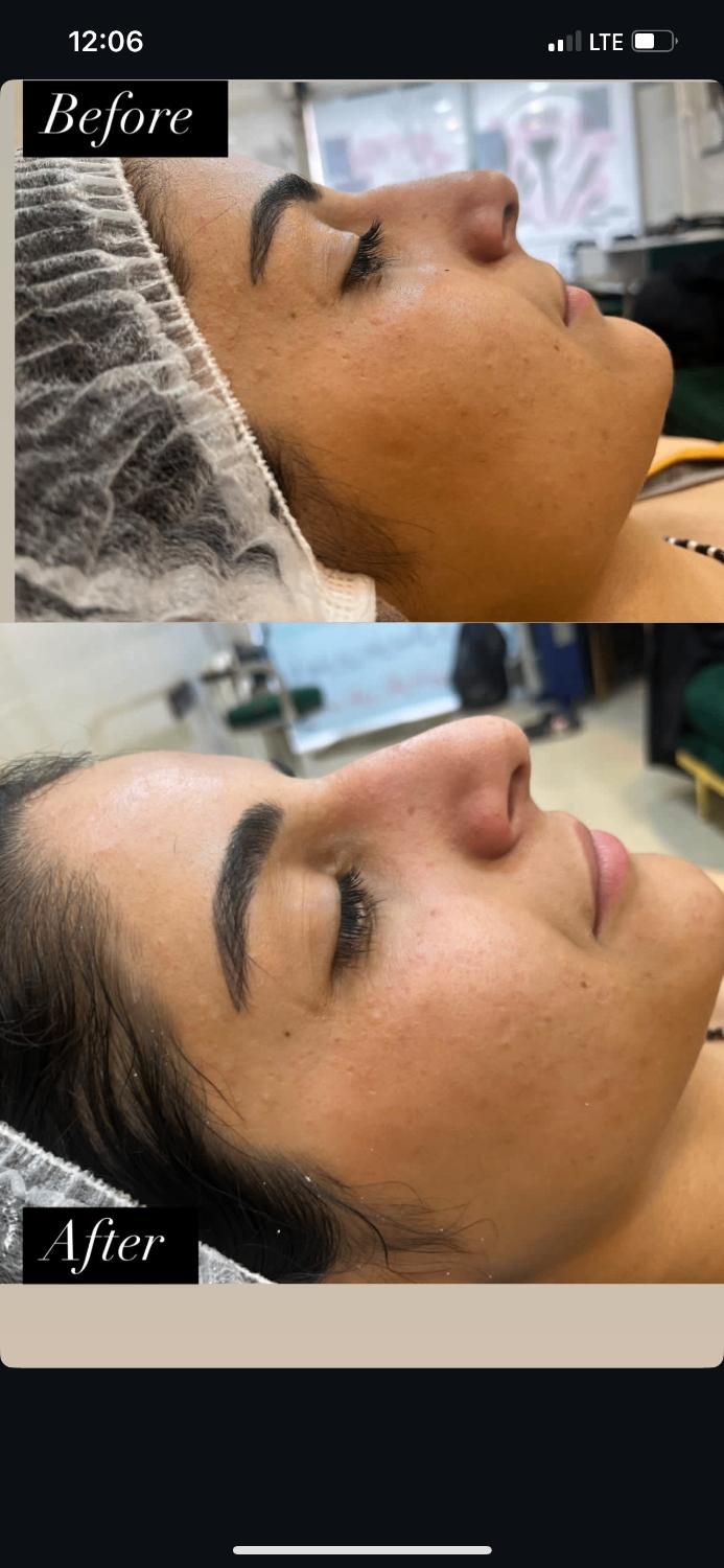 آموزش فشیال صورت. پاکسازی تخصصی و مدل پاکسازی پوست|خدمات آرایشگری و زیبایی|رشت, معلم|دیوار