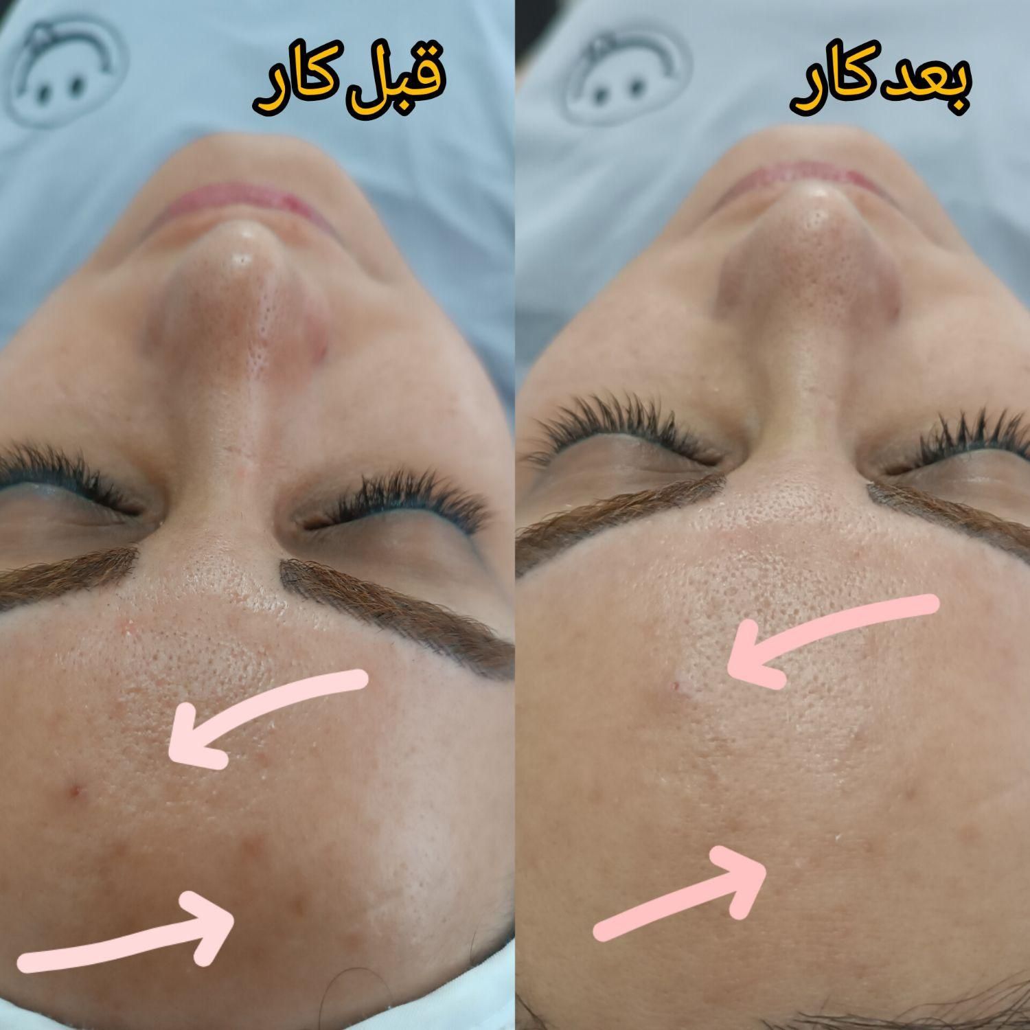 انواع فیشال و پاکسازی پوست در حوزه زیبایی|خدمات آرایشگری و زیبایی|لاهیجان, انقلاب|دیوار