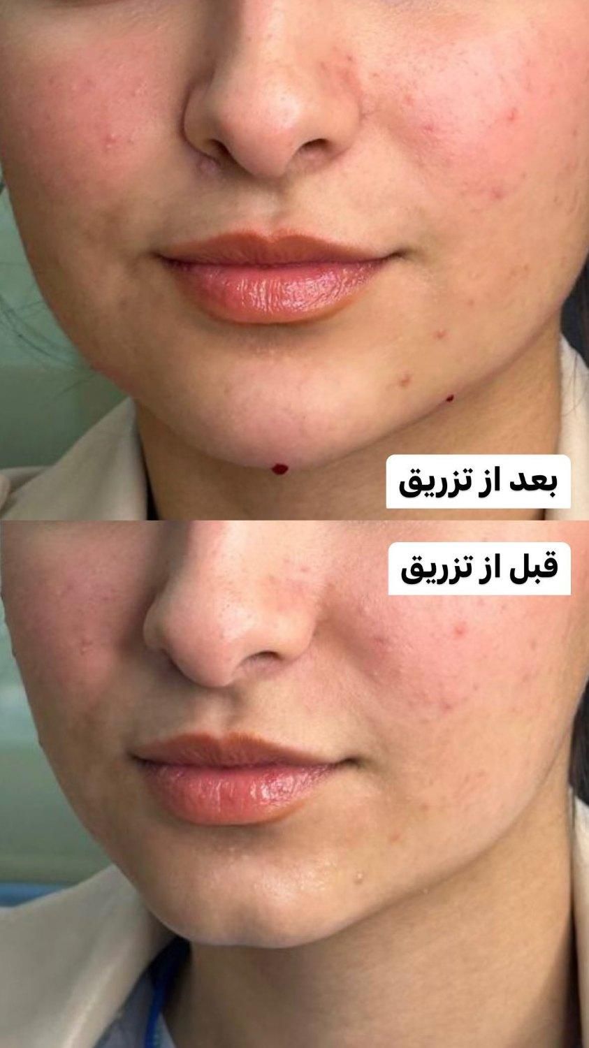 اگزوزوم/ریزش سکه ای/مزوتراپی/فیشیال/ریموو تاتو|خدمات آرایشگری و زیبایی|شیراز, کاراندیش|دیوار