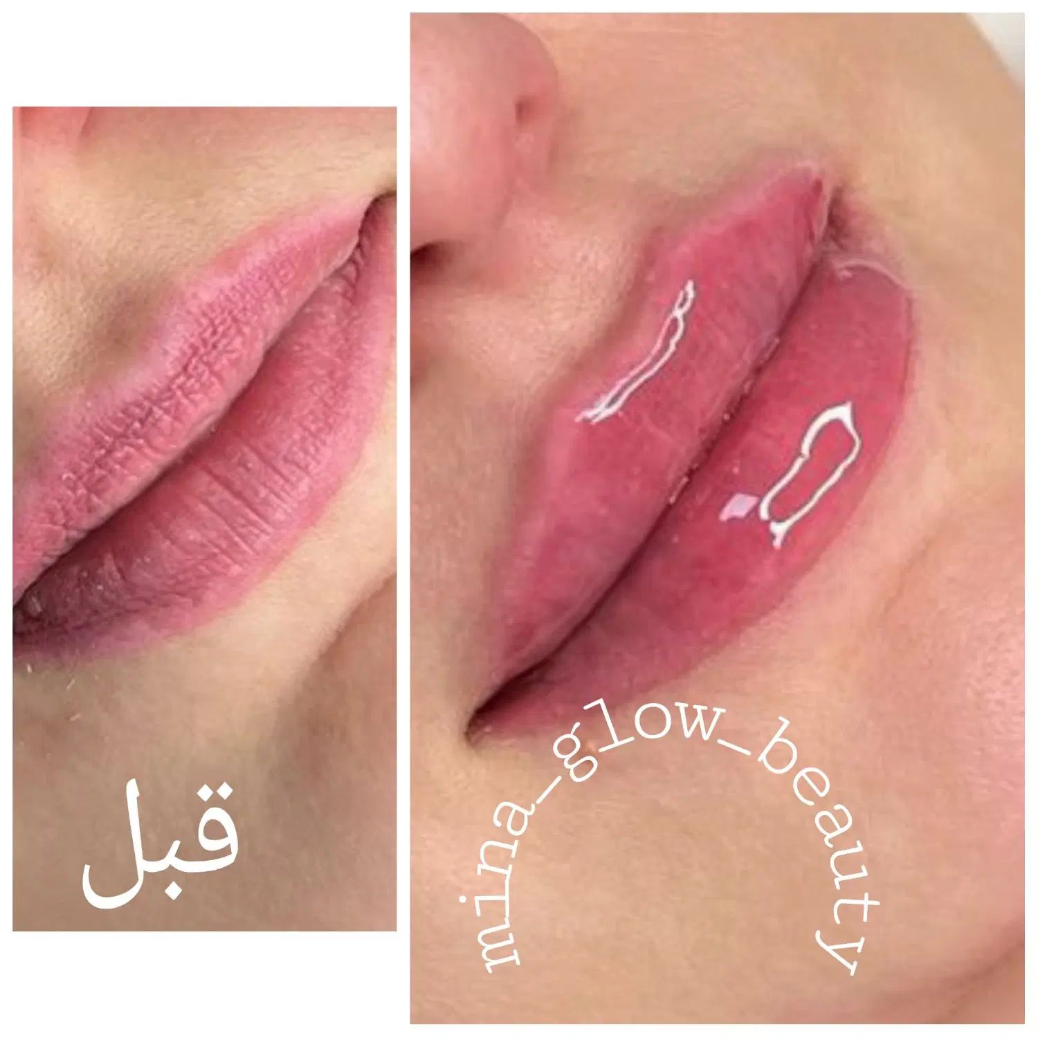 آموزش  و ارائه  ژل و بوتاکس و مزو|خدمات آموزشی|شیراز, سینما سعدی|دیوار