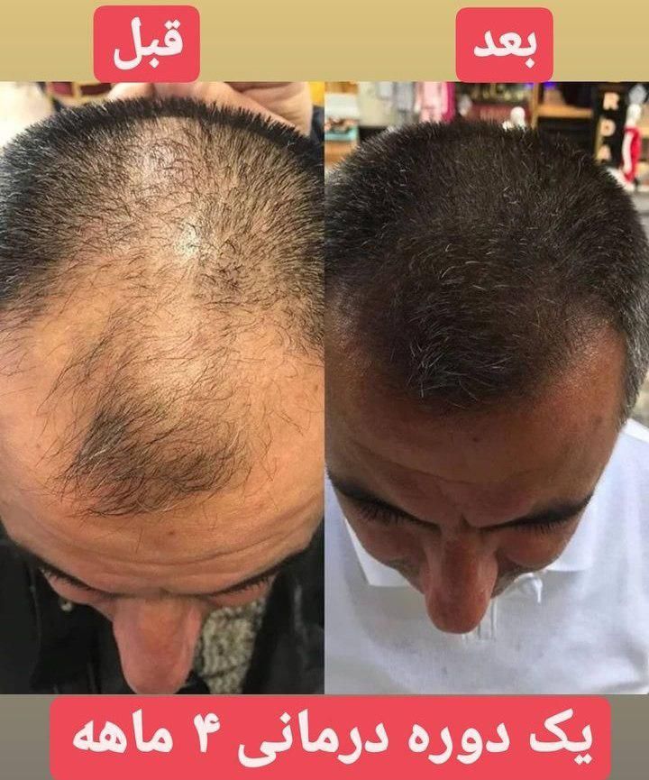 مشاوره ریزش مو و رویش مجدد|خدمات آرایشگری و زیبایی|مشهد, کلاهدوز|دیوار