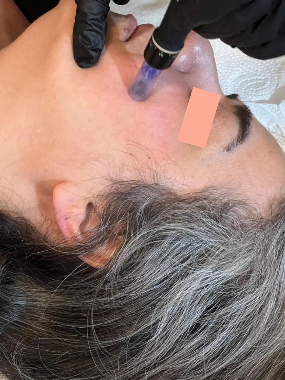 مزونیدلینگ صورت(جوان‌سازی،برطرف کردن جای جوش و لک)|خدمات آرایشگری و زیبایی|بابل, |دیوار