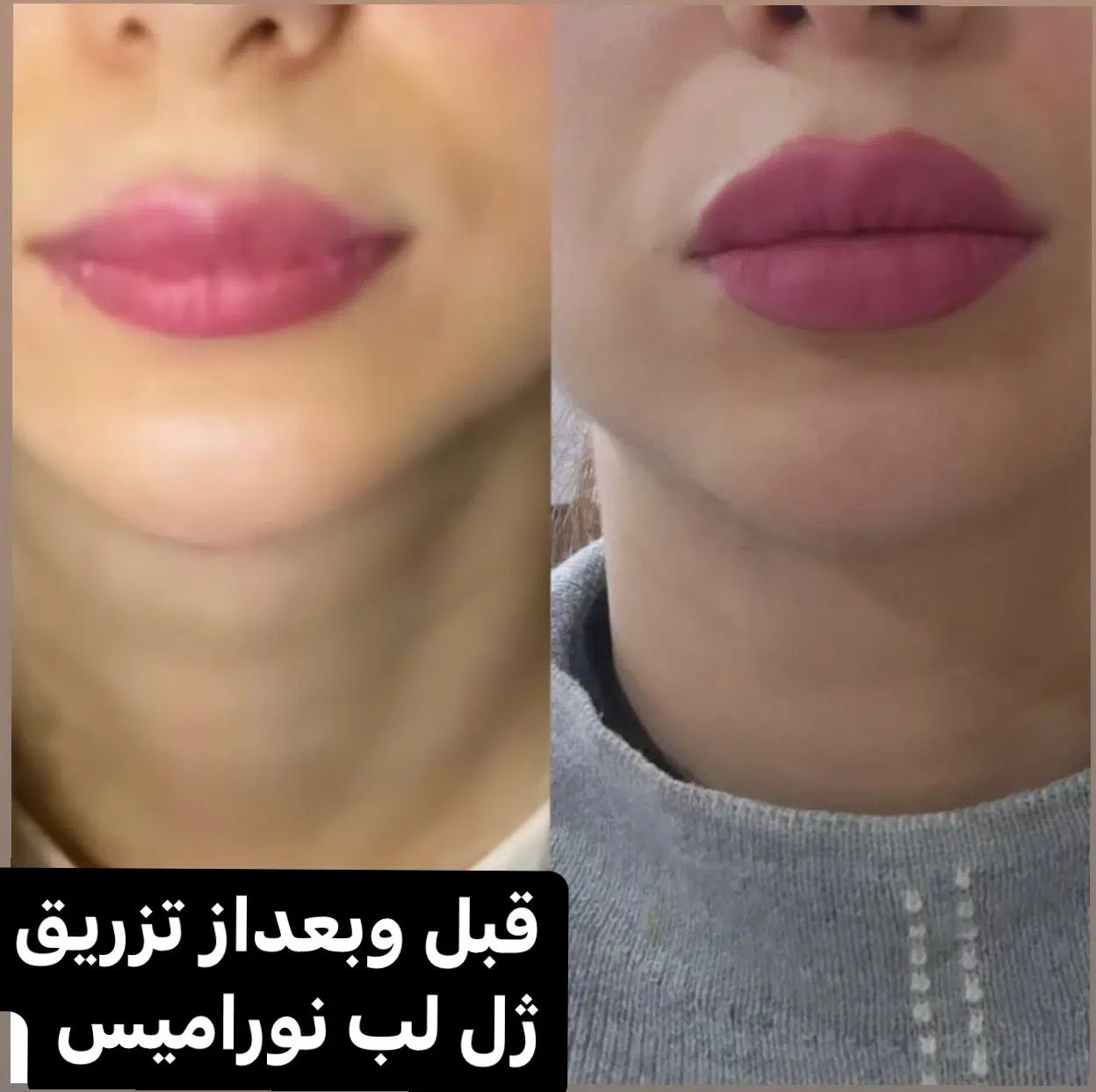 آف هفتگی تزریق ژل و بوتاکس و مزوژل جوانساز|خدمات آرایشگری و زیبایی|آمل, |دیوار