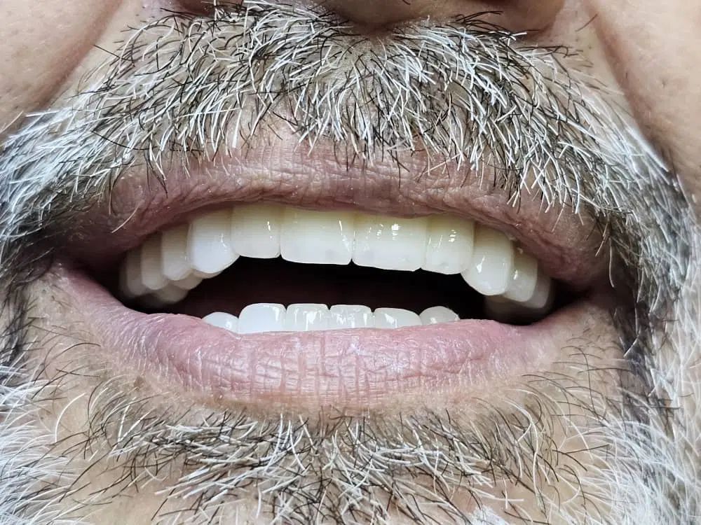 ایمپلنت کره ای ۶/۹۰۰ تخفیف بیشتربا دریافت کدتخفیف|خدمات آرایشگری و زیبایی|تهران, شهرآرا|دیوار