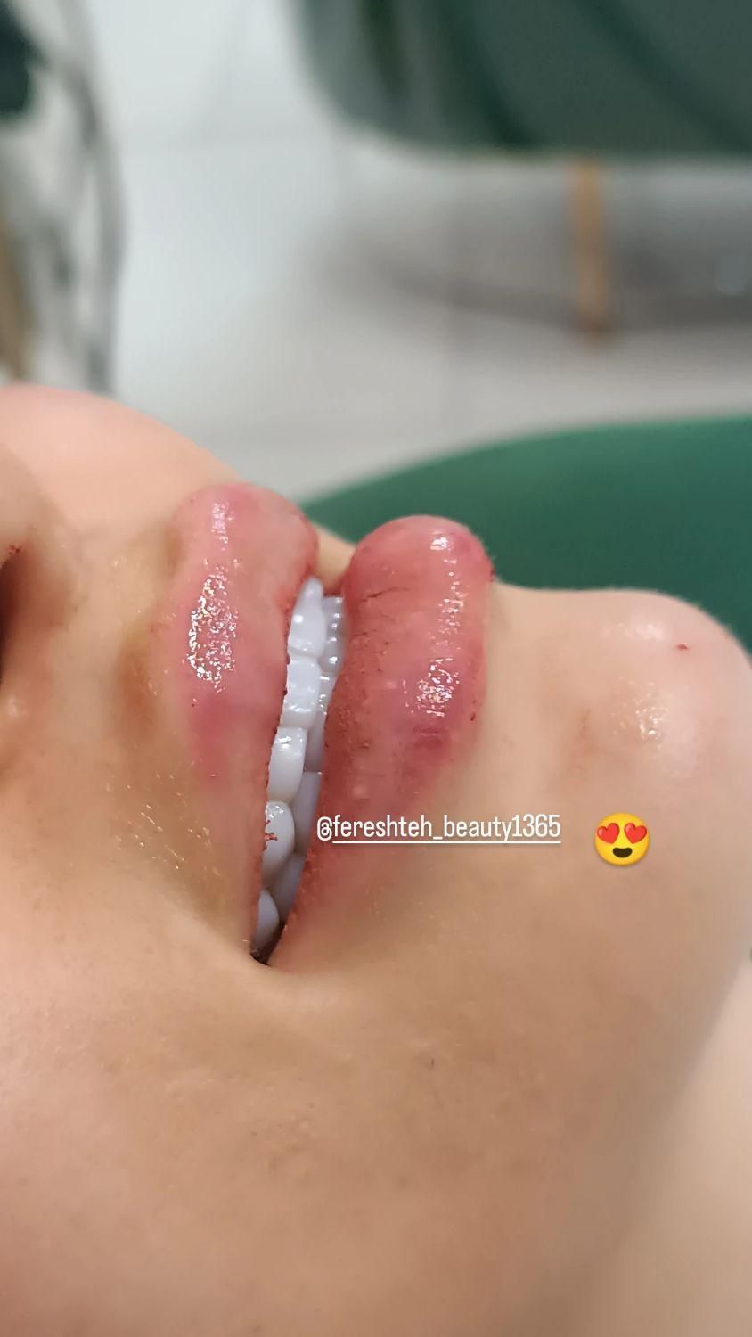 خدمات تزریق فیلر صورت بوتاکس مزوتراپی ولیزر|خدمات آرایشگری و زیبایی|نسیم‌شهر, |دیوار