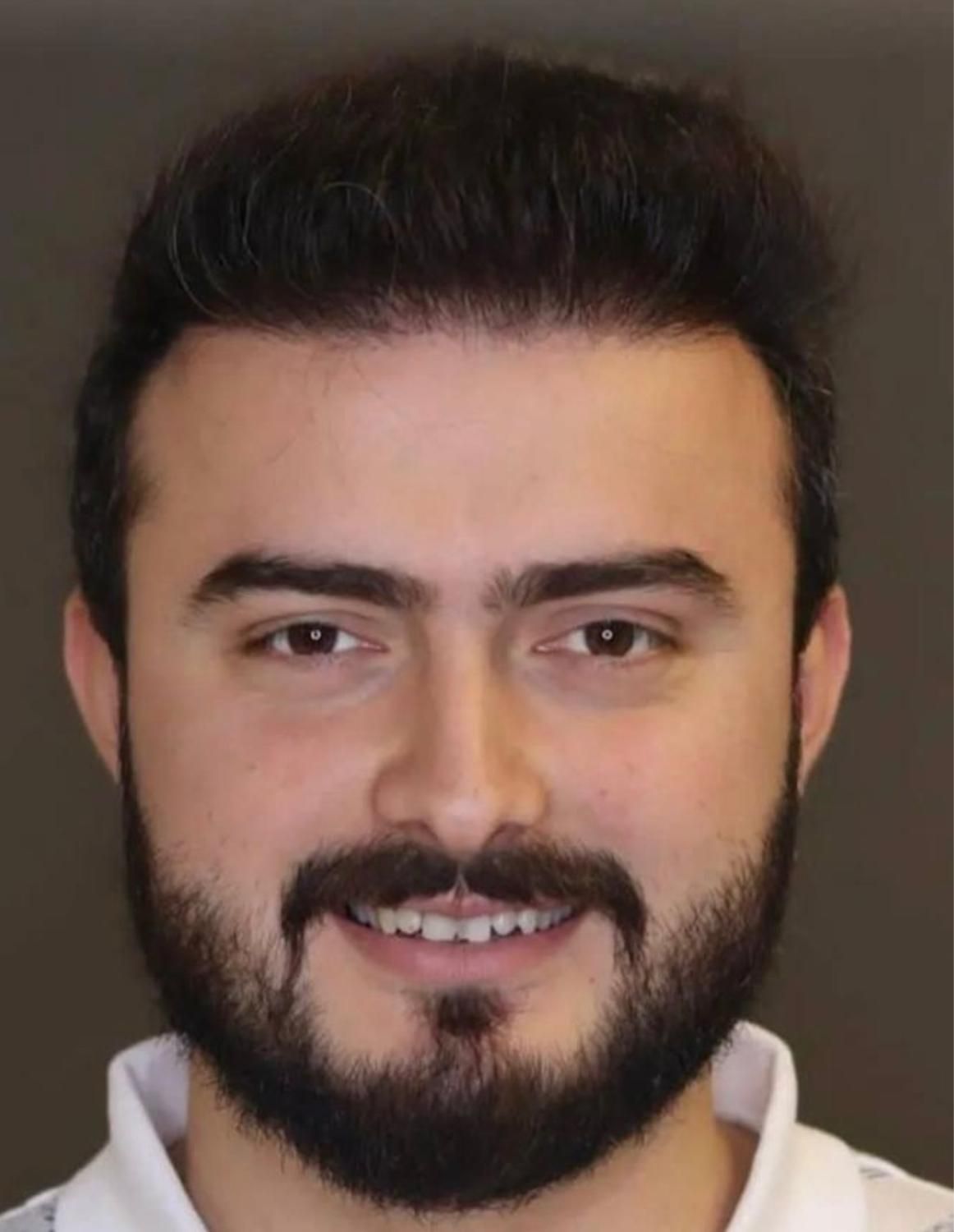 کاشت مو ابرو ریش بدون جراحی ضمانتنامه مادام العمر|خدمات آرایشگری و زیبایی|تهران, الهیه|دیوار