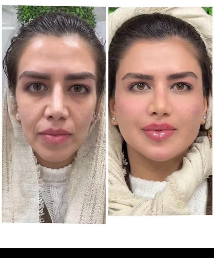 پکیج طلایی نقره ایی برنز لیفت با فیلر ژل بوتاکس|خدمات آرایشگری و زیبایی|مشهد, سناباد|دیوار