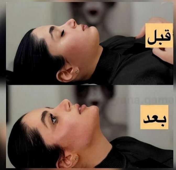 بوتاکس لیبل دار واحدی ۲۰۰ ژل اورجینال توسط پزشک|خدمات آرایشگری و زیبایی|اصفهان, احمدآباد|دیوار
