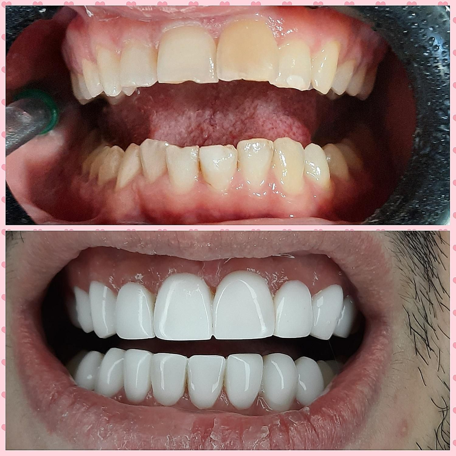 کامپوزیت دندان درمحل شمامنزل یامحل کار|خدمات آرایشگری و زیبایی|هشتگرد, شهرک گلخانه|دیوار