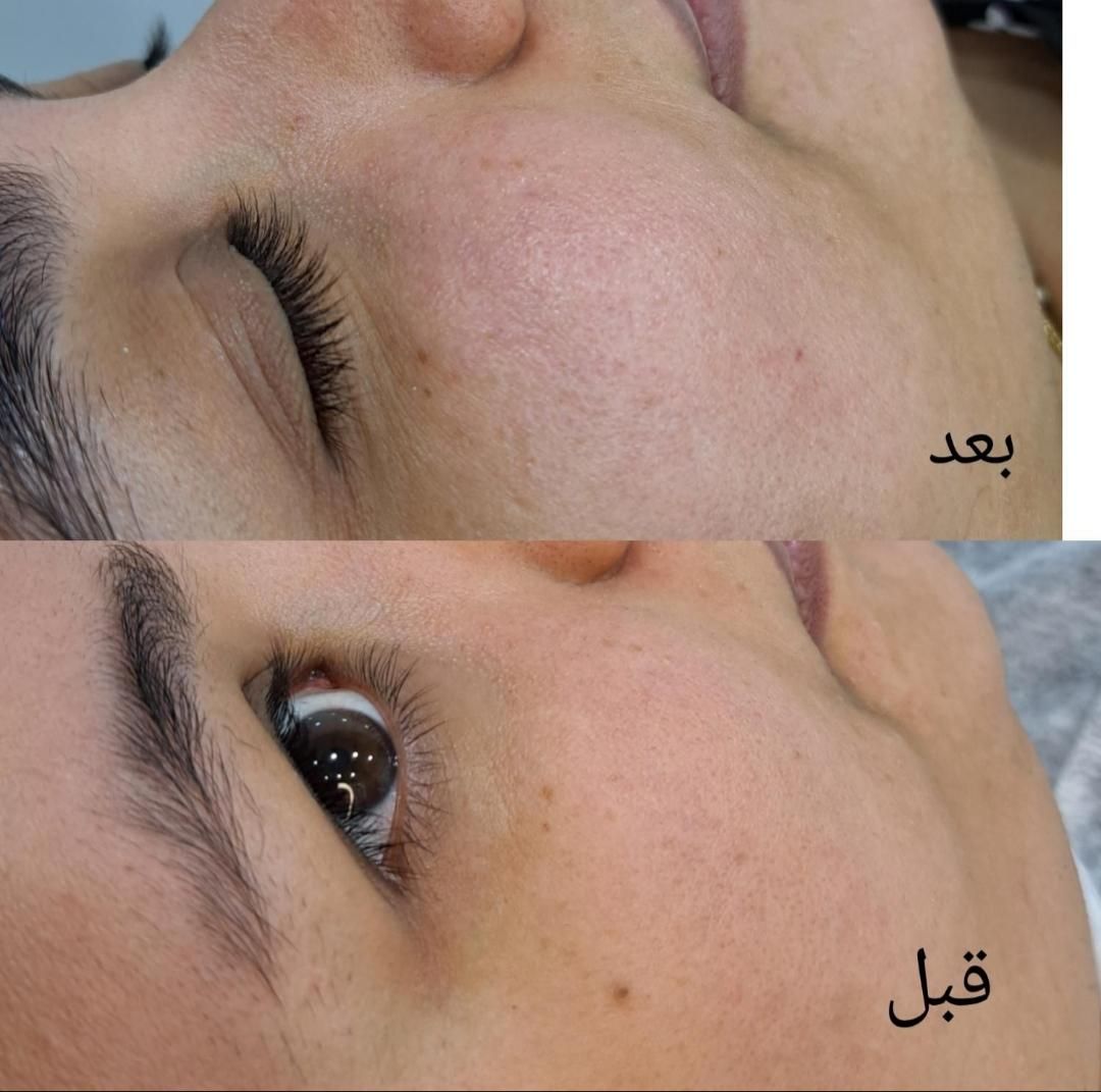 فیشیال و پاکسازی تخصصی پوست|خدمات آرایشگری و زیبایی|قم, قلعه کامکار|دیوار