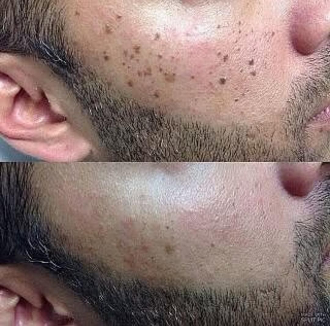 خدمات خالبرداری،برداشتن منگوله گوشتی|خدمات آرایشگری و زیبایی|تهران, مسعودیه|دیوار