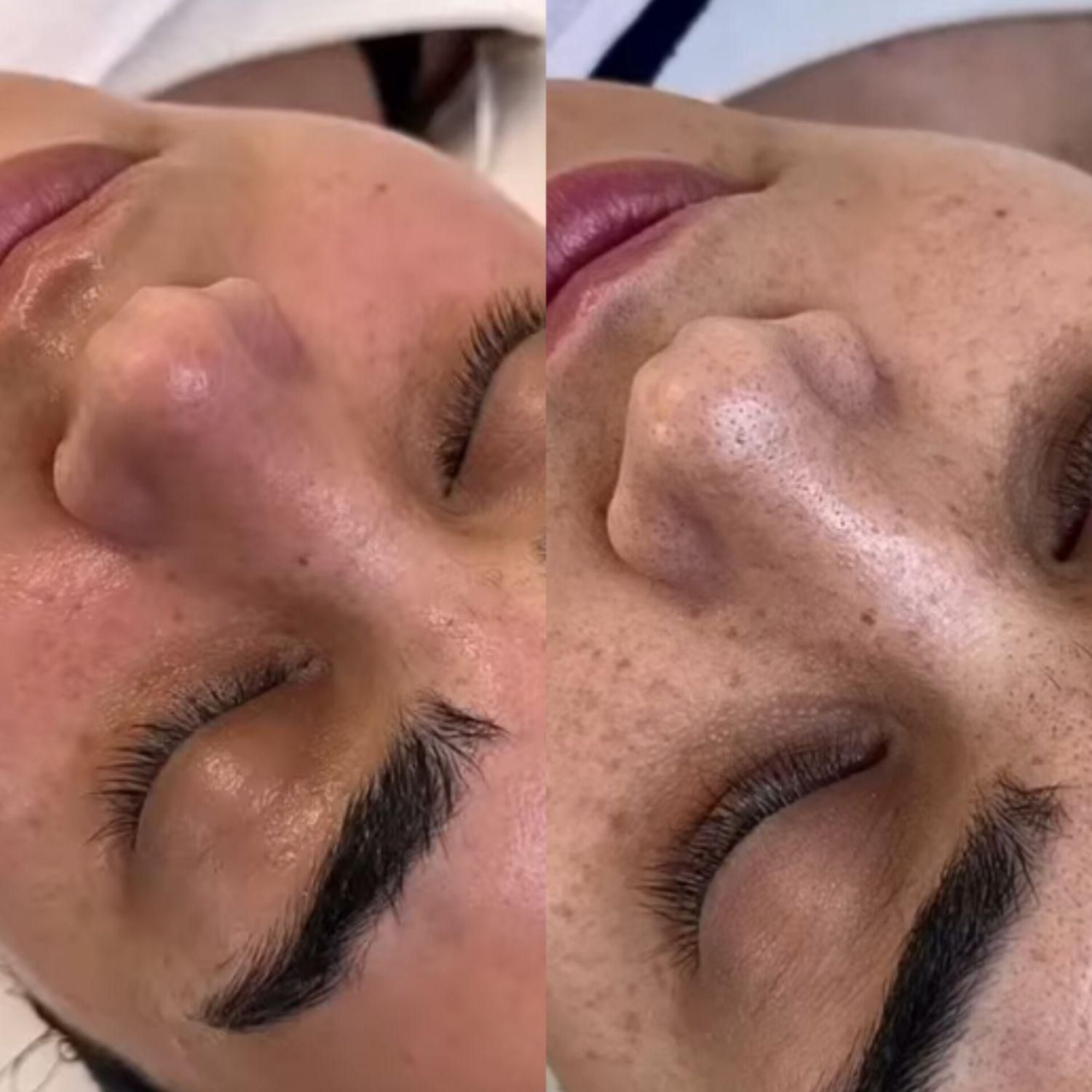 پاکسازی پوست به همراه دستگاه شروع قیمت از 280|خدمات آرایشگری و زیبایی|شیراز, کاراندیش|دیوار