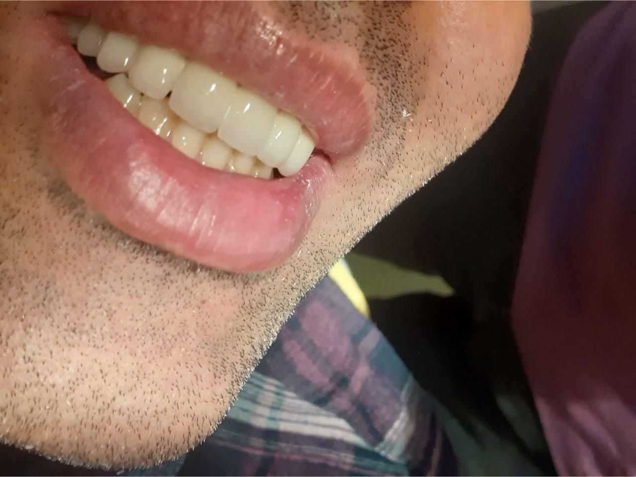 روکش های دندانی(پروتز های دندانی)|خدمات آرایشگری و زیبایی|ارومیه, |دیوار