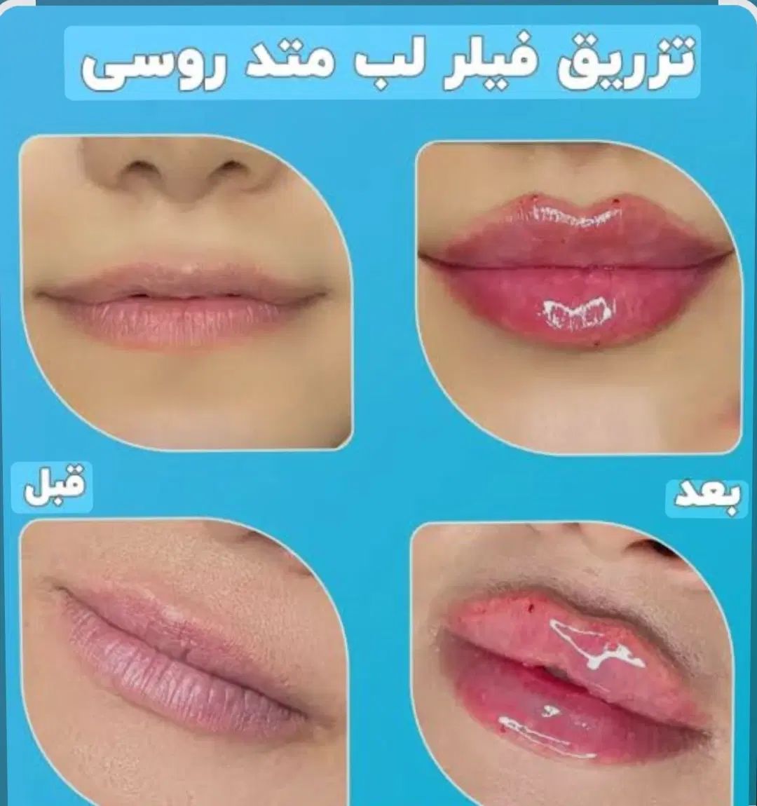 50٪تخفیف خدمات فیلر بوتاکس مزوتراپی پرسینگ چال لپ|خدمات آرایشگری و زیبایی|اصفهان, مولوی|دیوار