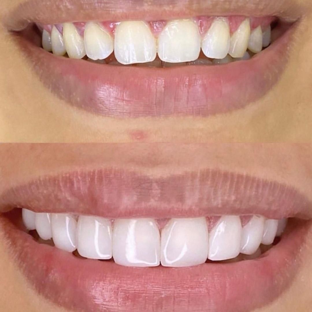 دندانپزشکی کامپوزیت عصبکشی|خدمات آرایشگری و زیبایی|نسیم‌شهر, |دیوار