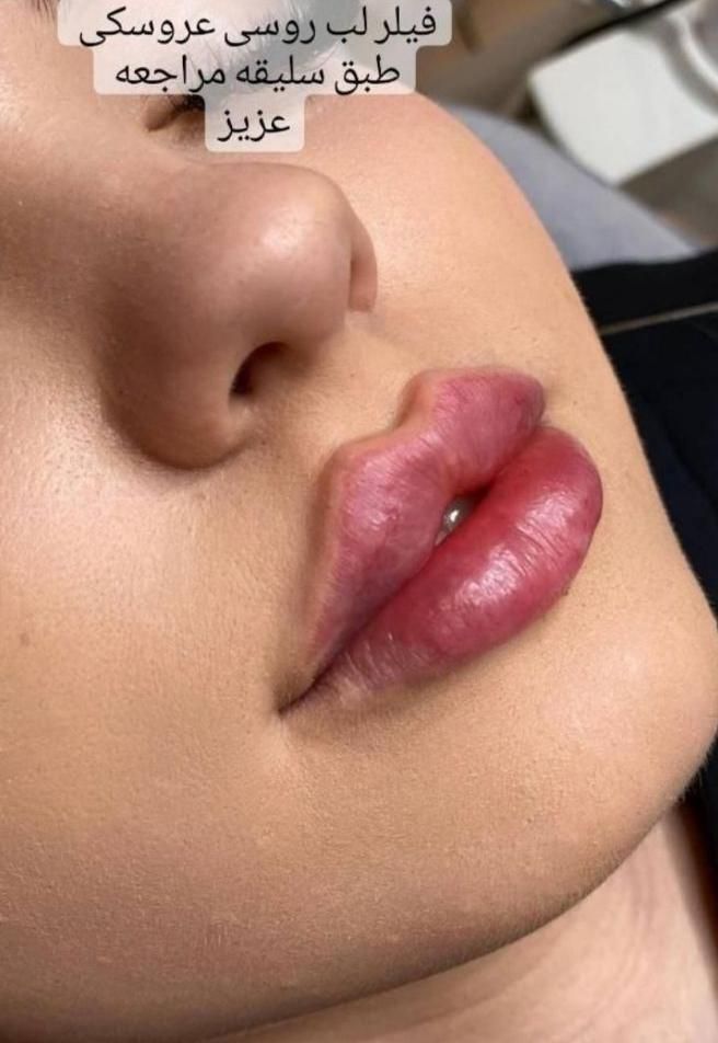 کلینیک تخصصی  خدمات زیبایی(ژل و بوتاکس ) با تخفیف|خدمات آرایشگری و زیبایی|کاشان, فین کوچک|دیوار