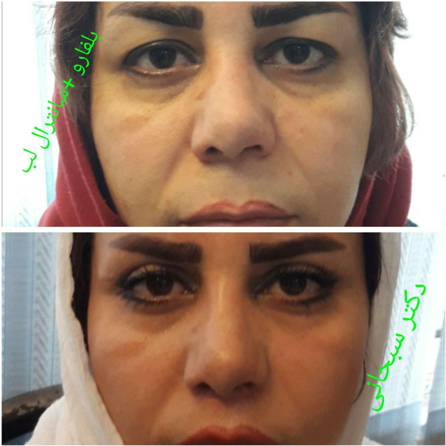 بلفاروپلاستی جراحی پلک لیفت شقیقه ابرو صورت بوتاکس|خدمات آرایشگری و زیبایی|تهران, سلسبیل جنوبی|دیوار