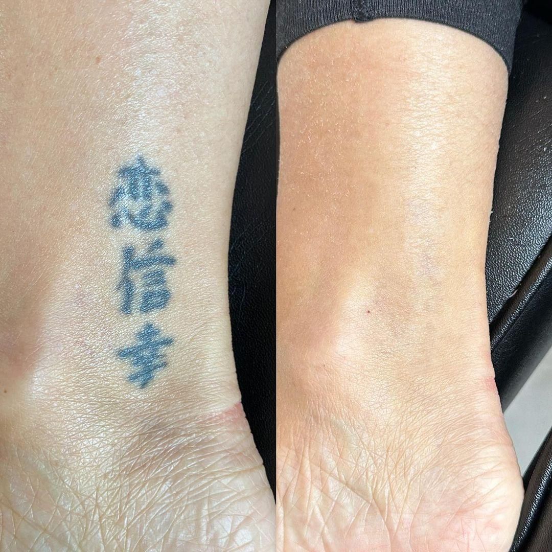 ۴۰٪ تخفیف پاک کردن تتو و خالکوبی با لیزرQ-switch|خدمات آرایشگری و زیبایی|کرمانشاه, |دیوار