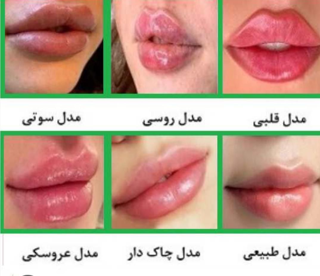 تزریق فیلر و بوتاکس و هایفو|خدمات آرایشگری و زیبایی|تهران, شهر زیبا|دیوار