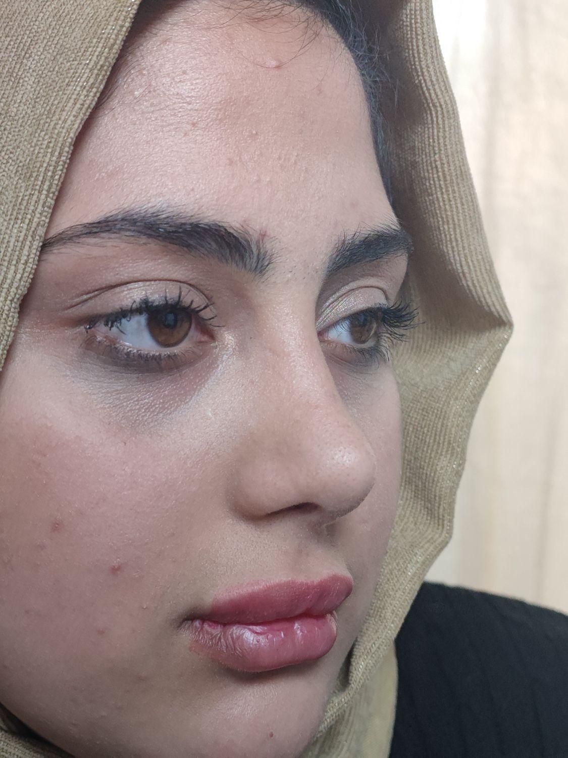 زیبایی بینی۲۹تومن با متخصص گوش و حلق و بینی|خدمات آرایشگری و زیبایی|ورامین, ورامین|دیوار