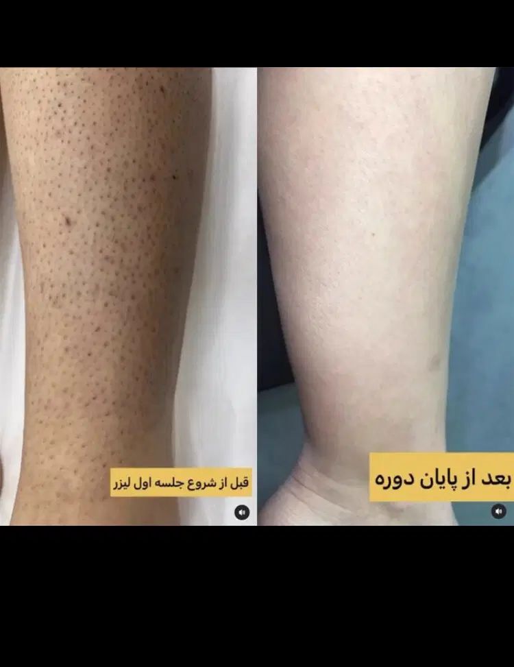 لیزر موهای زائد ‌‌و فیشال باجدیدترین دستگاهه اهواز|خدمات آرایشگری و زیبایی|اهواز, گلستان|دیوار
