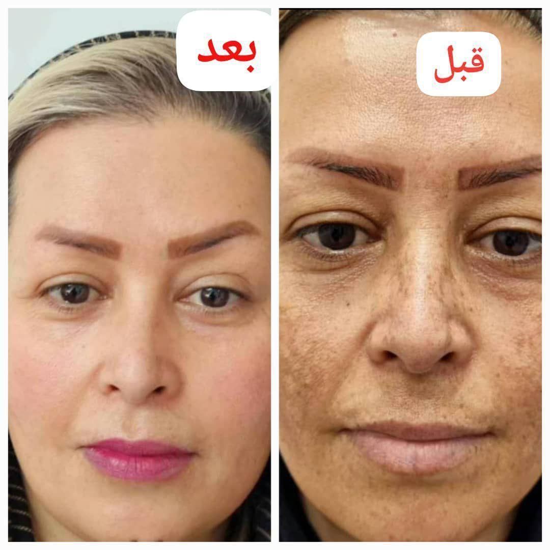 کرم معجزه صد در صد تضمینی با 10سال سابقه کار|آرایشی، بهداشتی، درمانی|خرمشهر, |دیوار
