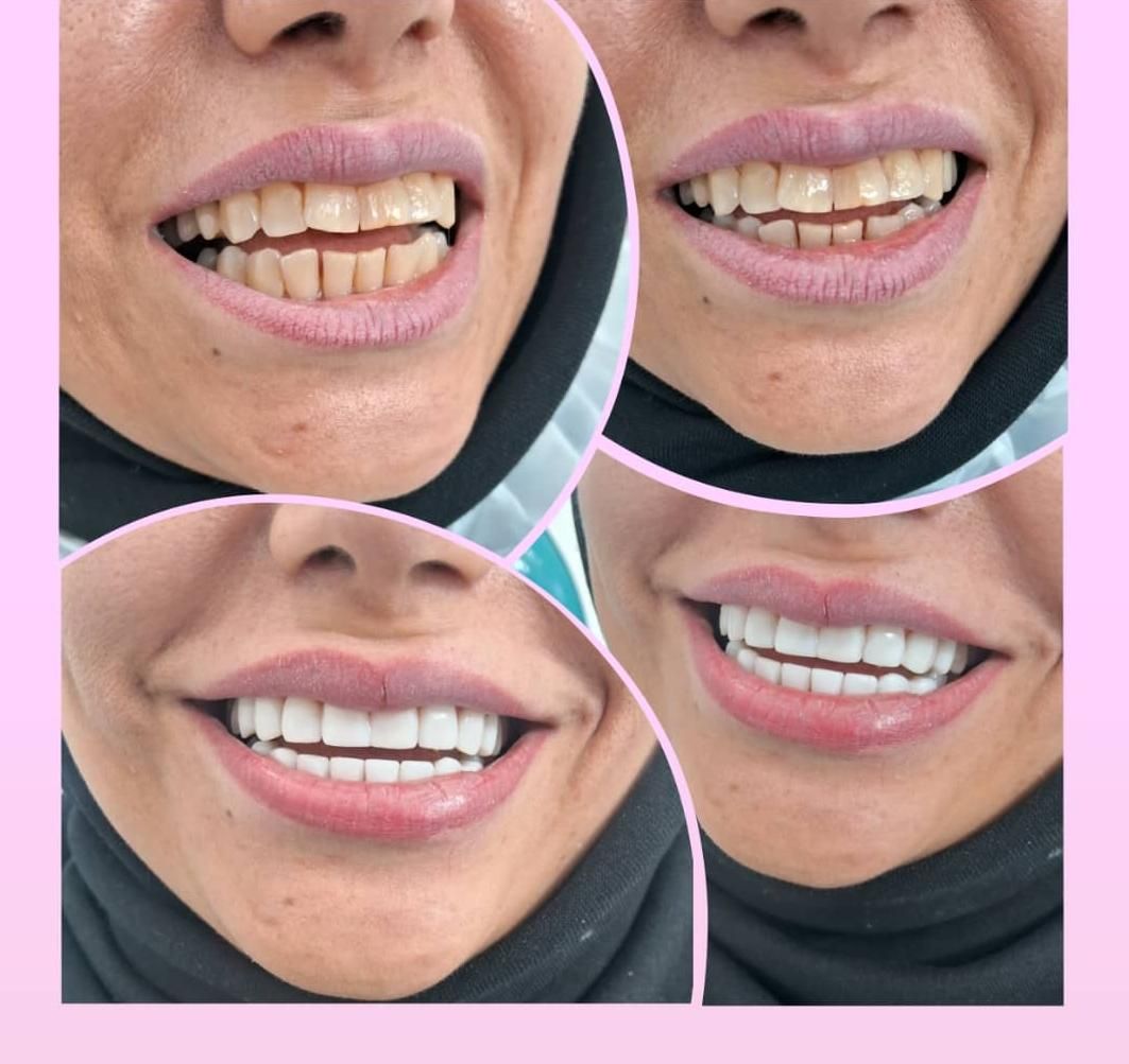 کلیه خدمات دندانپزشکی با تخفیف ویژه|خدمات آرایشگری و زیبایی|قم, سراجه|دیوار