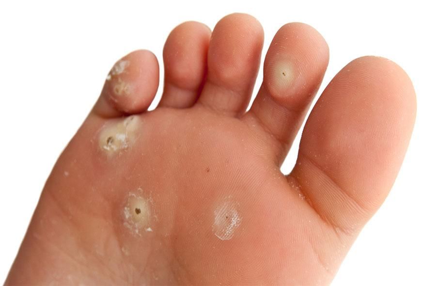 زگیل خال گوشتی و مخچه و...|خدمات آرایشگری و زیبایی|سرپل ذهاب, |دیوار