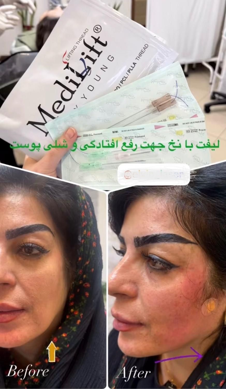 فیلر لب زیر چشم فیلر بادی نخ لیفت پی ار پی مزو|خدمات آرایشگری و زیبایی|اصفهان, سیچان|دیوار