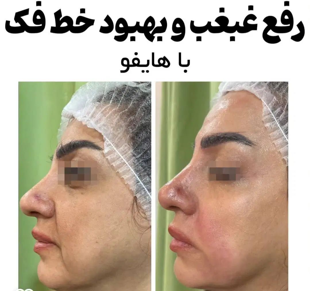 هایفوتراپی رفع چین و چروک پوست با بروزترین تجهیزات|خدمات آرایشگری و زیبایی|شیراز, قدوسی غربی|دیوار