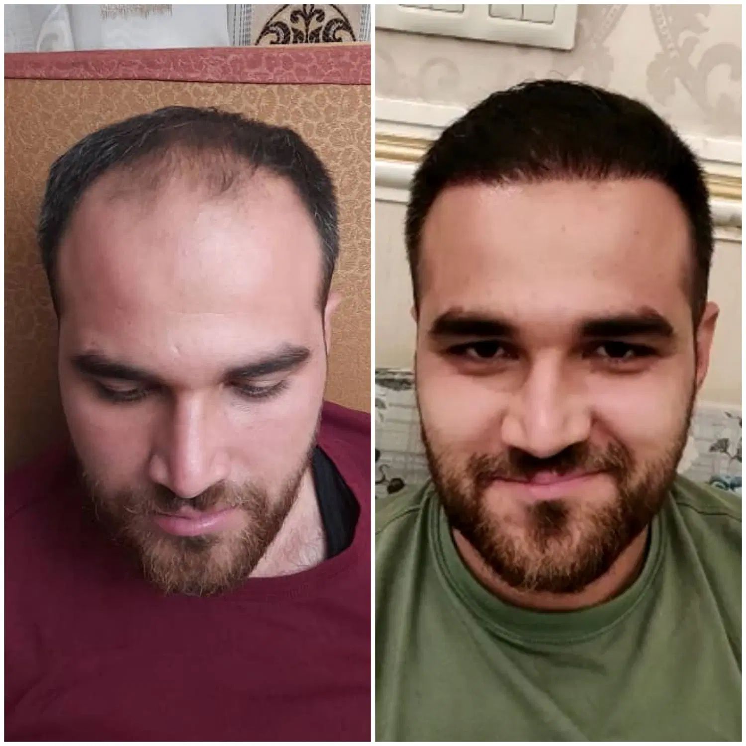 کاشت مو فول تراکم اقساطی برای اولین بار در رفسنجان|خدمات آرایشگری و زیبایی|رفسنجان, |دیوار