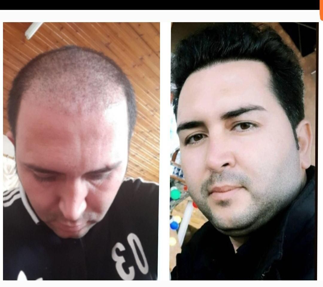 کاشت مو پرتراکم بدون جراحی و کاشت ابرو|خدمات آرایشگری و زیبایی|رشت, گلباغ نماز|دیوار