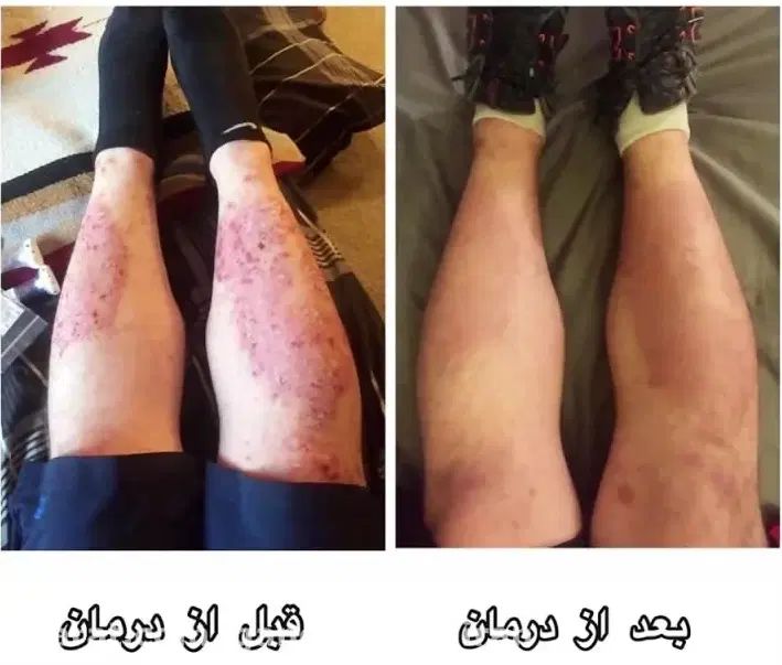 درمان پسوریازیس یا صدفک با گیاهان درمانی|آرایشی، بهداشتی، درمانی|اهواز, دانشگاه چمران|دیوار