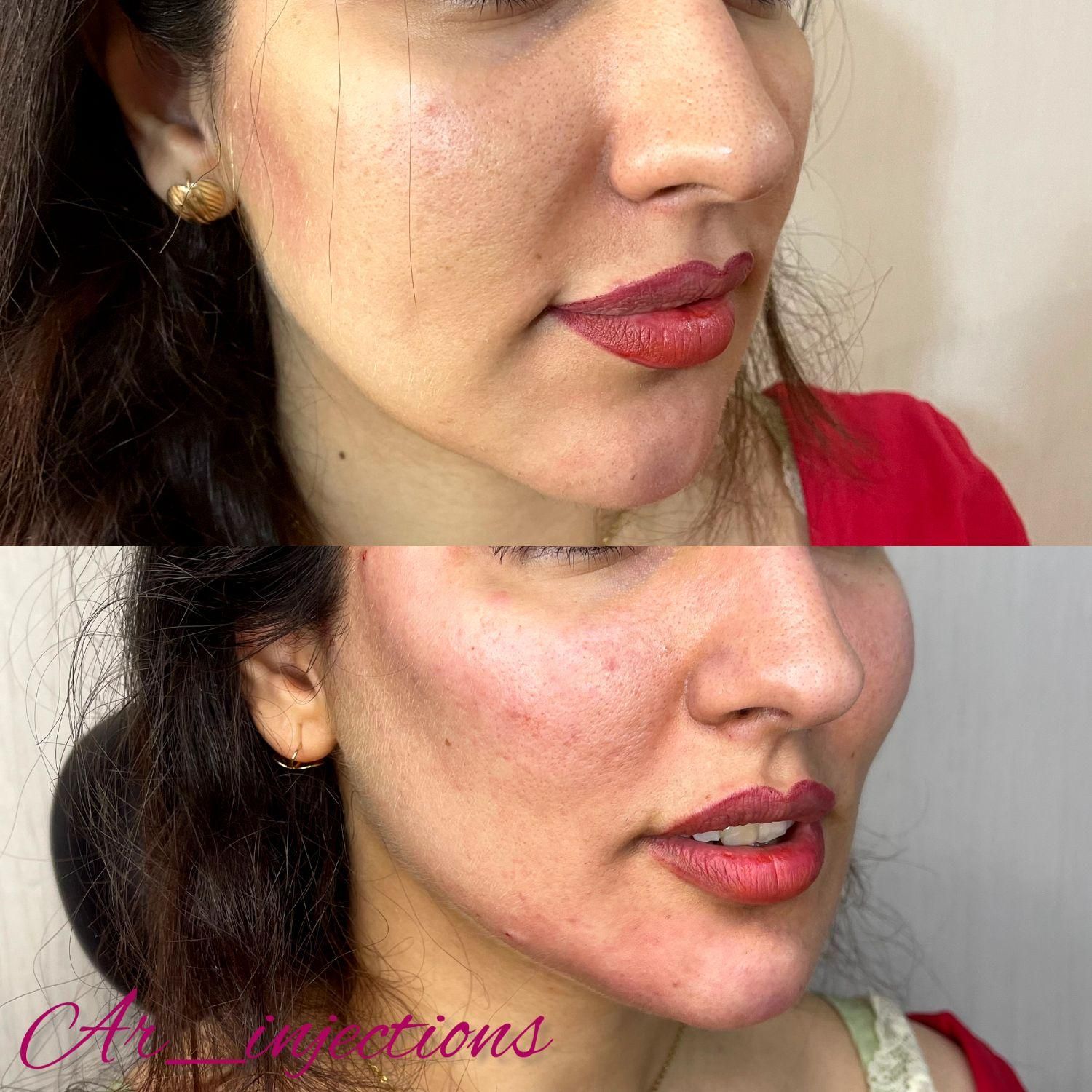 آموزش و تزریق ژل و بوتاکس|خدمات آرایشگری و زیبایی|مسجد سلیمان, |دیوار