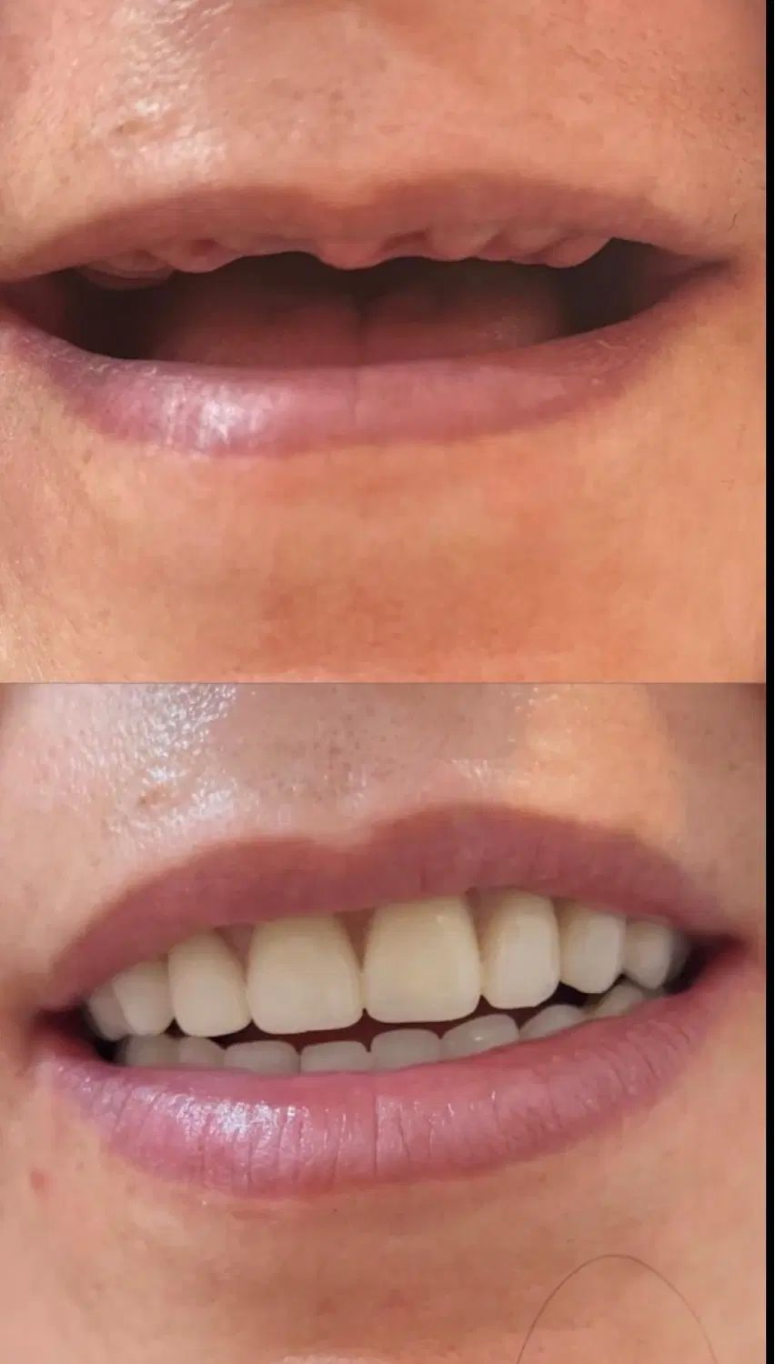 دندان مصنوعی تخصص ماست ( اقساط )|خدمات آرایشگری و زیبایی|اصفهان, لاله|دیوار