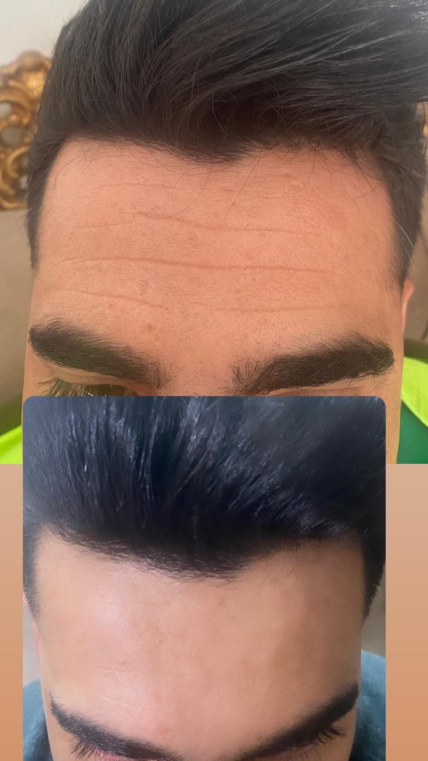 تزریق بوتاکس کل صورت و زیر بغل|خدمات آرایشگری و زیبایی|کرمانشاه, |دیوار