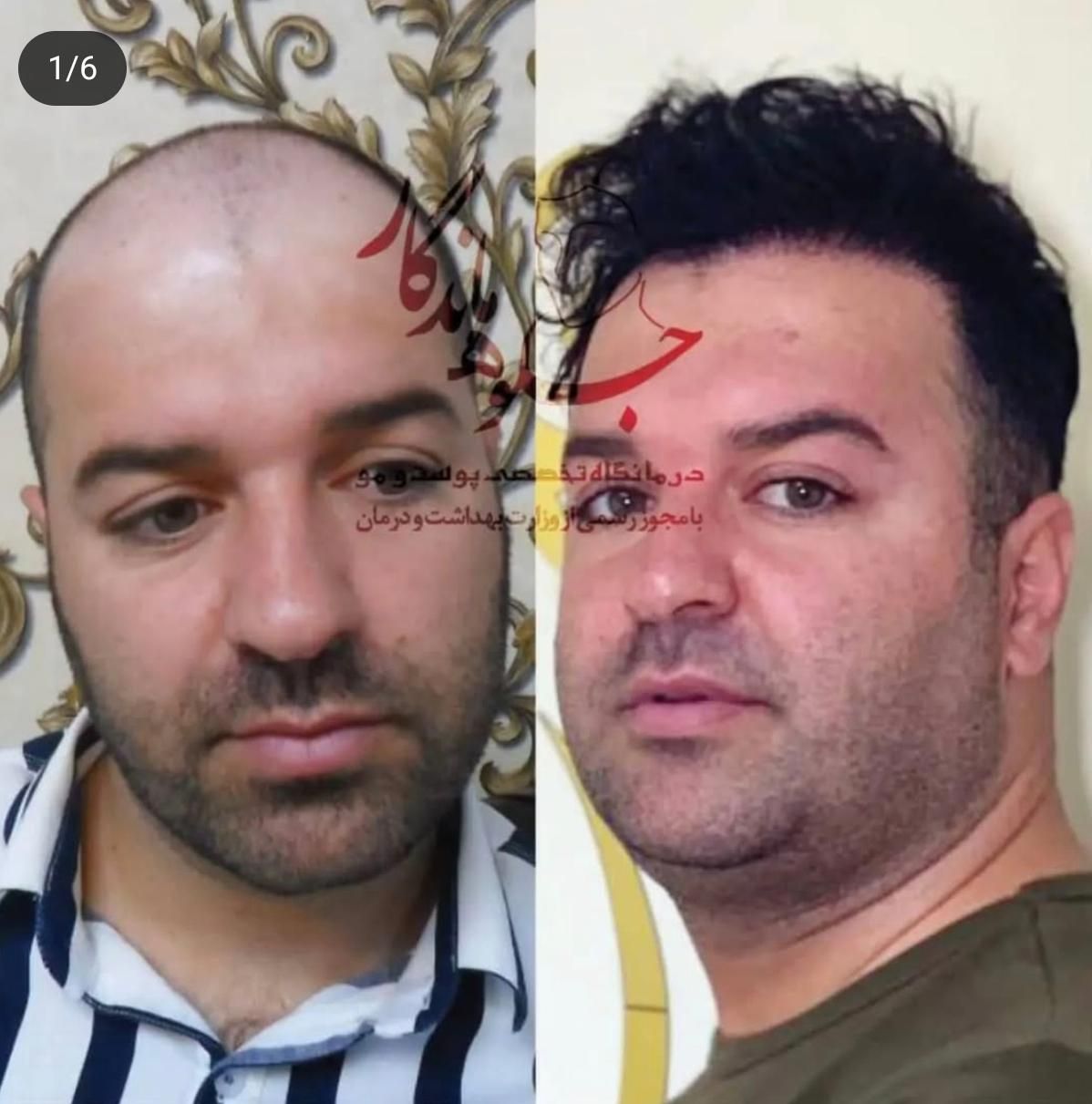 کاشت مو با جدیدترین متد روز دنیا|خدمات آرایشگری و زیبایی|تهران, عباس‌آباد|دیوار