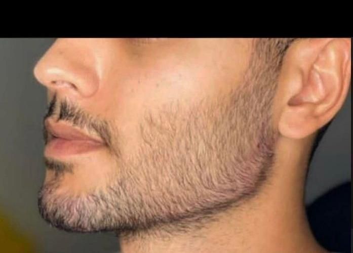 جشنواره تزریق ژل و بوتاکس و لیفت نخ و مزو چربی سوز|خدمات آرایشگری و زیبایی|کرمانشاه, |دیوار