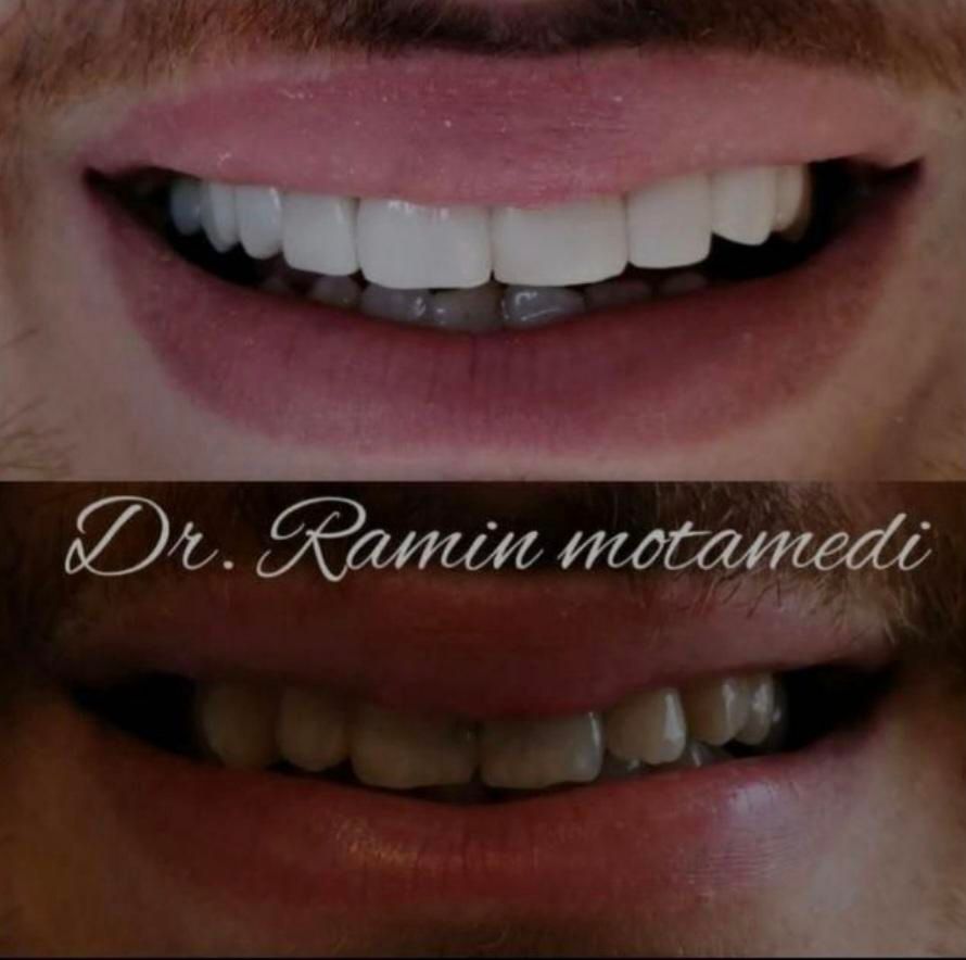 ایمپلنت/کامپوزیت/دندانپزشکی/اقساط|خدمات آرایشگری و زیبایی|شیرگاه, |دیوار