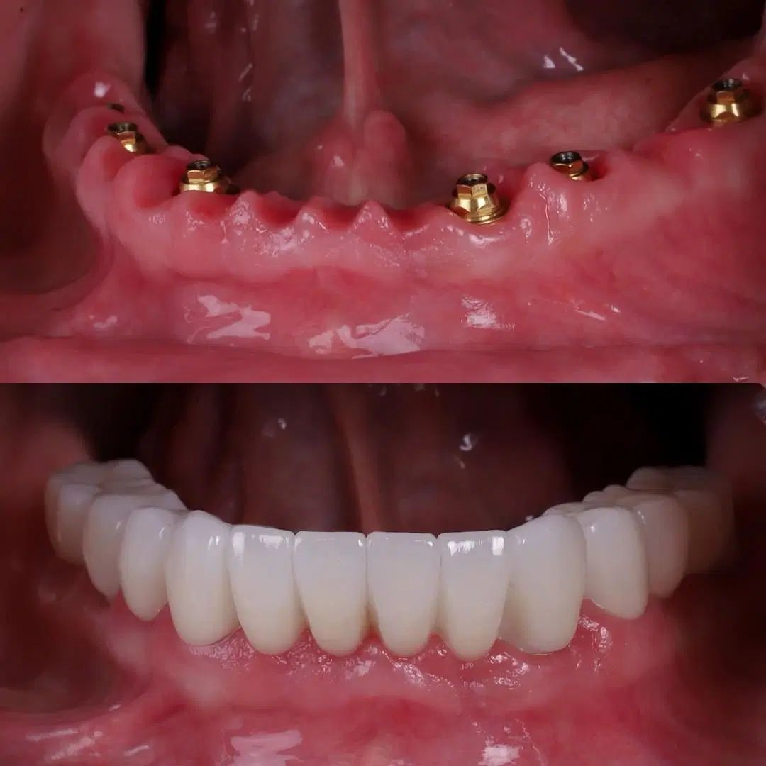 دندانپزشکی تخصصی ایمپلنت دیجیتالی و فوری|خدمات آرایشگری و زیبایی|تبریز, |دیوار