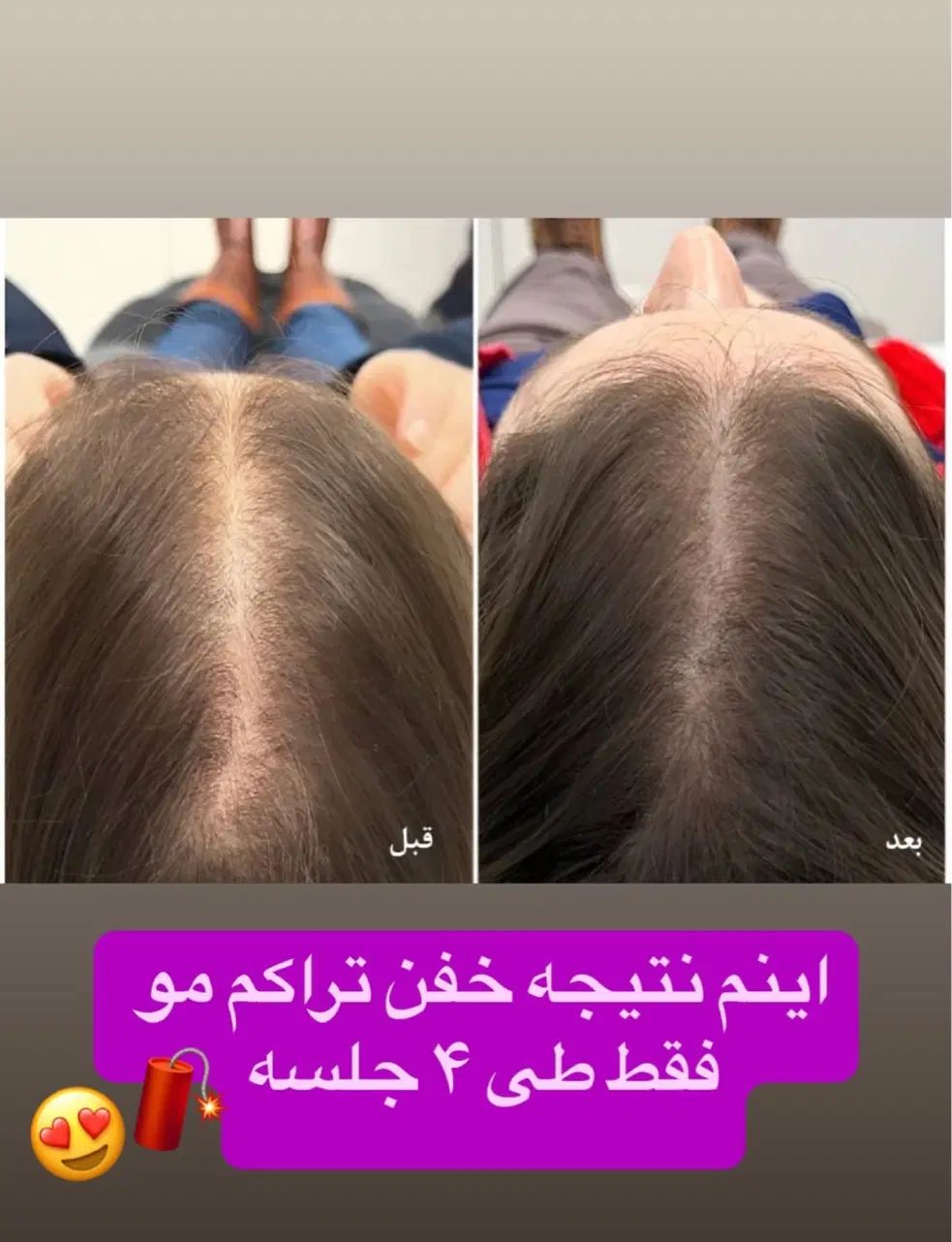 درمان ریزش مو و رویش مجدد با بهترین متریال|خدمات آرایشگری و زیبایی|تهران, امام حسین|دیوار
