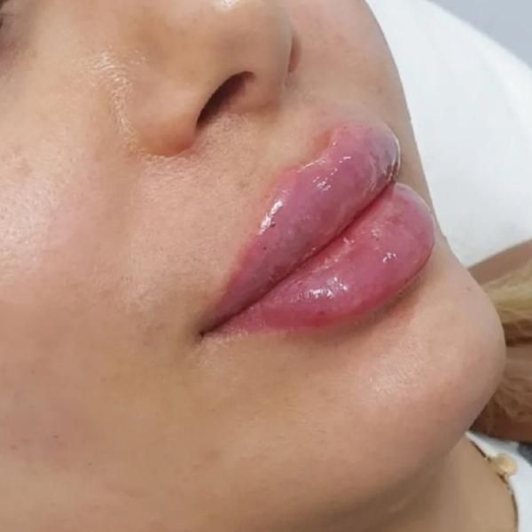 ژل بوتاکس فیلر پی ارپی مزوتراپی خال زگیل کک ومک|خدمات آرایشگری و زیبایی|شیراز, رحمت‌آباد|دیوار