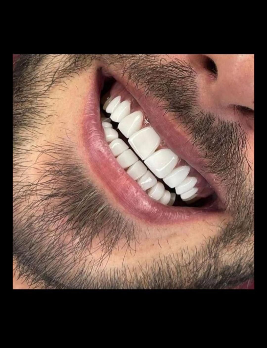 دندانپزشکی کامپوزیت لمینت|خدمات آرایشگری و زیبایی|قم, پردیسان|دیوار