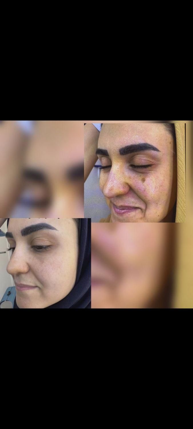 درمان تک جلسه ای تضمینی کک و مک ،لک،اسکار ،جوش|خدمات آرایشگری و زیبایی|قزوین, |دیوار