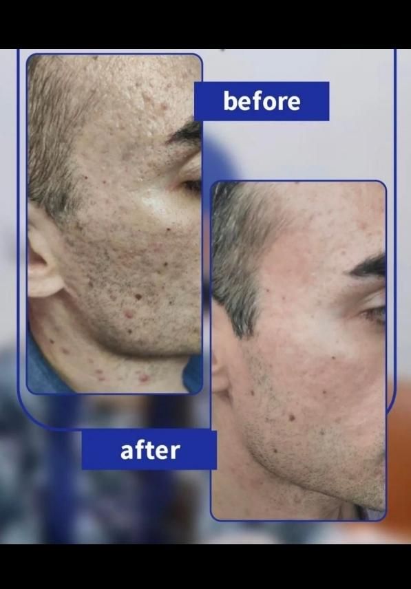 درمان همیشگی تورفتگی پوست/ جای جوش/اسکار/اگزوزوم|خدمات آرایشگری و زیبایی|اصفهان, سروستان|دیوار