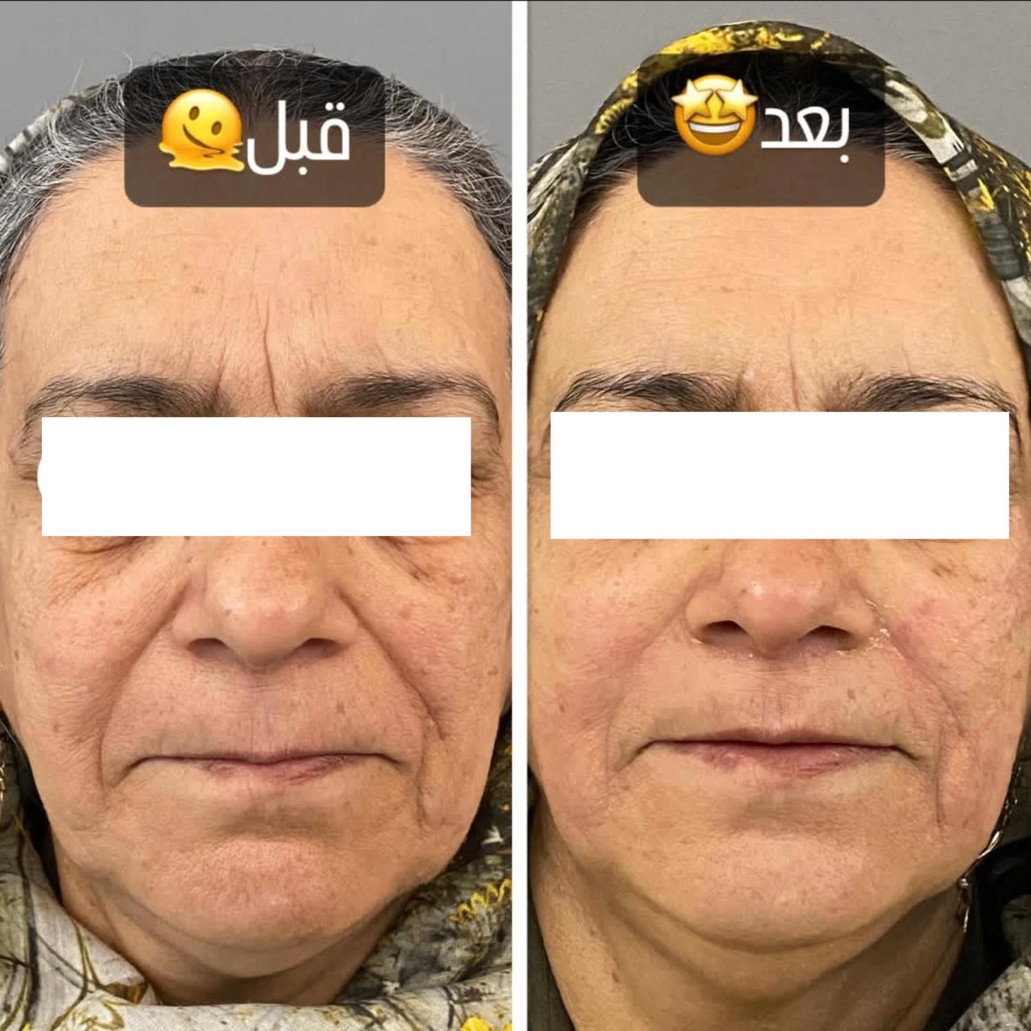 هایفوتراپی|خدمات آرایشگری و زیبایی|اصفهان, هزارجریب|دیوار