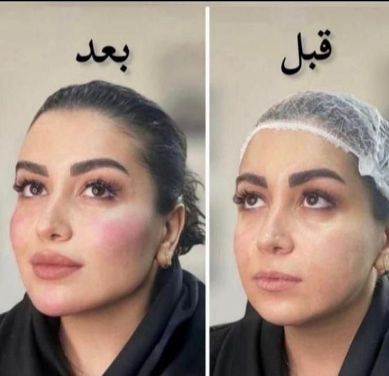 ژل بوتاکس فیلر چشم زاویه فک گونه چانه فشیال بیکینی|خدمات آرایشگری و زیبایی|قم, زنبیل آباد|دیوار