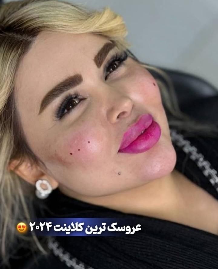 تزریق ژل،بوتاکس،فیلر،مزوتراپی،پی آر پی لیزر  هایفو|خدمات آرایشگری و زیبایی|اردبیل, |دیوار